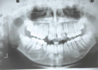含歯性のう胞
