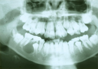 含歯性のう胞