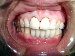下顎前歯部欠損症例