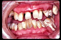 歯周病の難症例