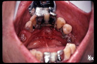 歯周病の難症例
